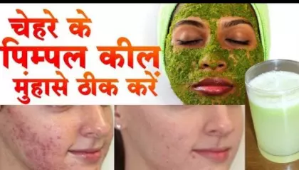pimple ke gharelu upay चेहरे पर मोजूद पिम्पल कम कैसे करें  _ how to reduce pimpl