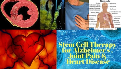 5 Stem Cell Therapy Benefits — for Joint Pain, Heart Disease & Even Alzheimer’s