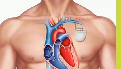 pacemaker/पेसमेकर,दिल की धड़कनों को नियमित करने के लिए