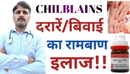 बिवाई! Chilblains Treatment/Homeopathy  ठंड में हाथ-पैर की सूजन का इलाज