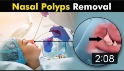 Nasal polyps and thair treatment  How Polypectomy  is performed? + (Urdu/Hendi)