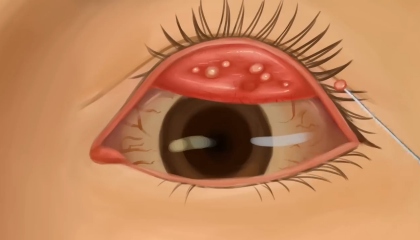 asmr eye conjunctivitis  treatment ll asmr eye stone removal animation