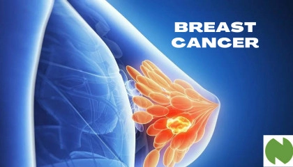 Breast Cancer  Breast Biopsy  Nucleus Health