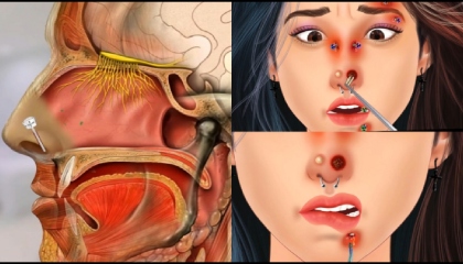 ASMR Treatment of  Nose Infection  Caused by Wearing Facial Piercing tranding