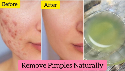 Toner for remove pimples naturally.