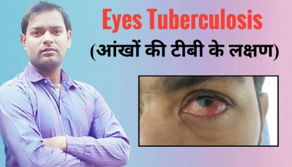आंखों में टीबी की बीमारी के लक्षण और कारण ।