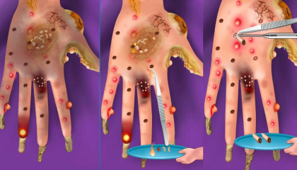 ASMR Remove Worm & Maggot Hand InfectedAsmr Worm Removal AnimationASMR Tuber
